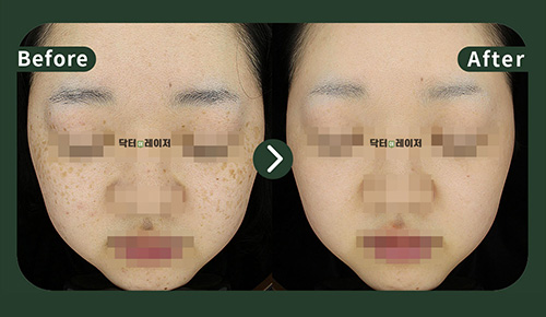[Melasma] 20s Before and after