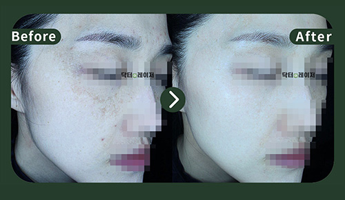 [Melasma] 40s Before and after