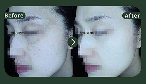 [Melasma] 40s Before and after
