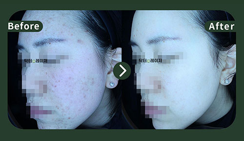 [Acne] 20s Before and after