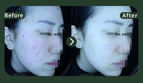 [Acne] 20s Before and after
