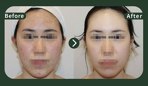 [Acne] 20s Before and after