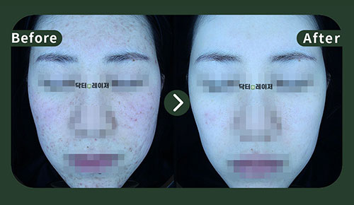 [Acne] 20s Before and after