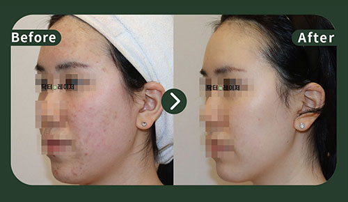 [Acne] 20s Before and after