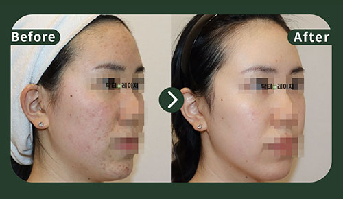[Acne] 20s Before and after