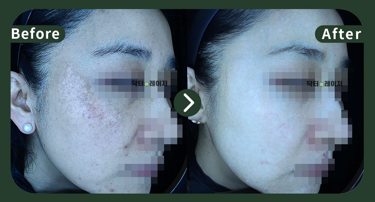 [Melasma] 40s Before and after
