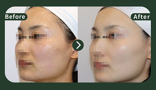 [Freckles]30s Before and after