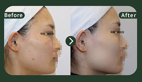 [Freckles]30s Before and after