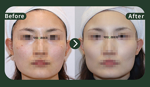 [Freckles]30s Before and after