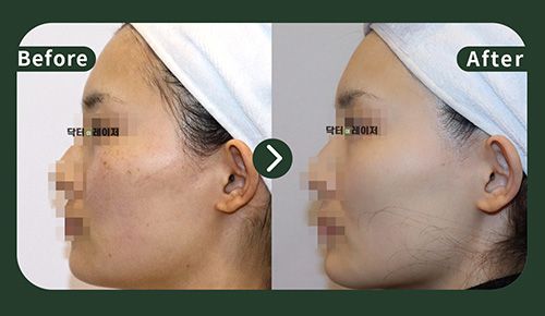 [Freckles]30s Before and after