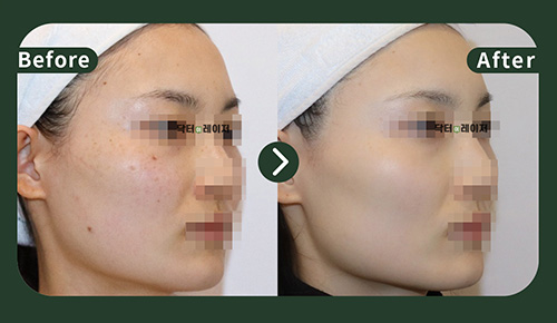 [Freckles]30s Before and after