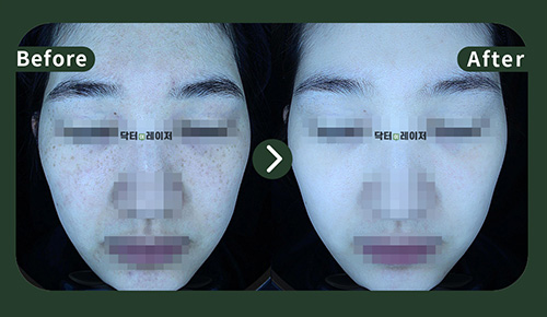 [Freckles]30s Before and after