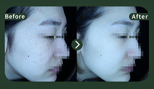 [Freckles]30s Before and after
