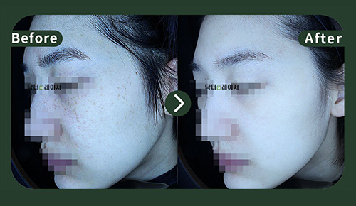 [Freckles]30s Before and after