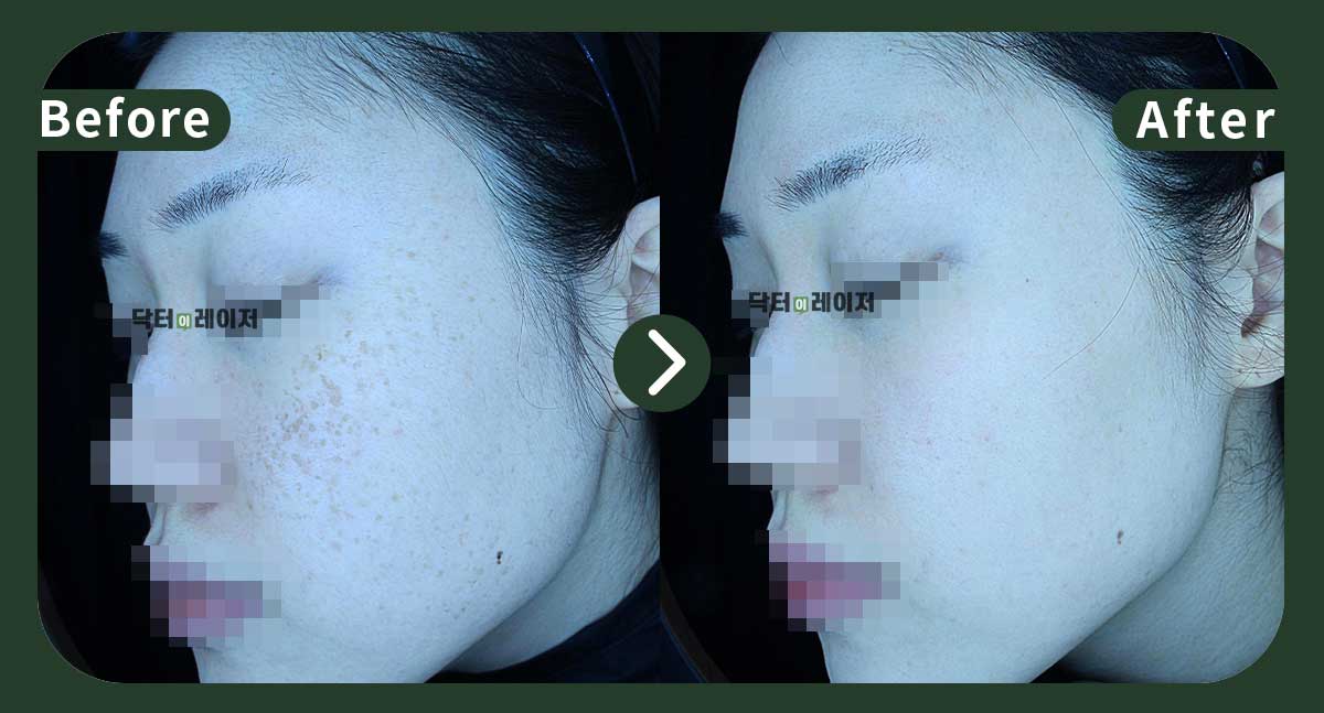 [Blemishes+Freckles] 30s Before and after