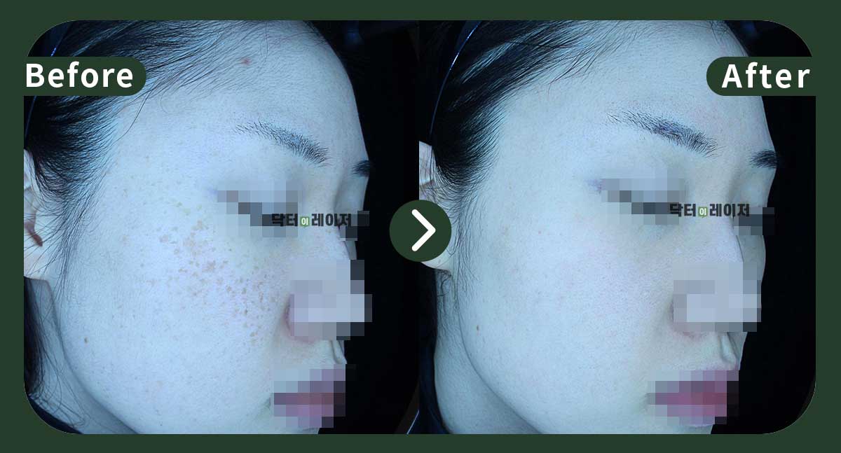[Blemishes+Freckles] 30s Before and after
