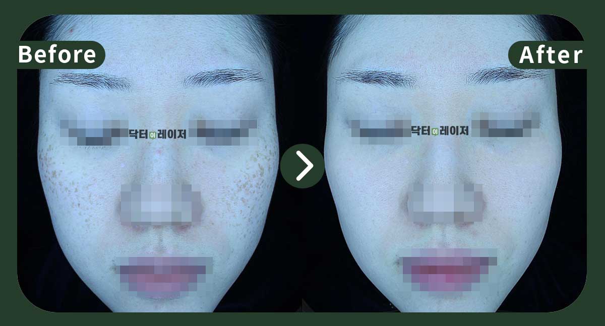 [Blemishes+Freckles] 30s Before and after