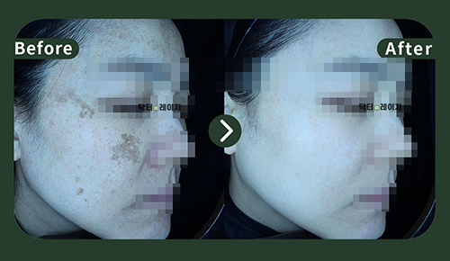 [Melasma] 40s Before and after