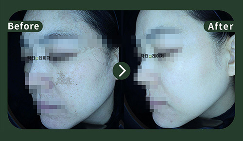 [Melasma] 40s Before and after