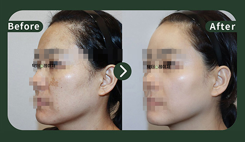 [Melasma] 40s Before and after