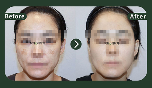 [Melasma] 40s Before and after