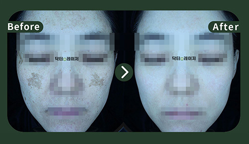 [Melasma] 40s Before and after