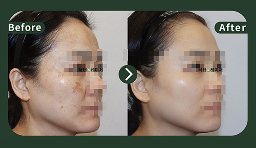 [Melasma] 40s Before and after